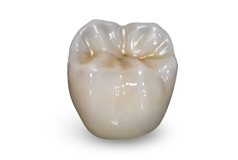 BruxZir Full Strength posterior crown